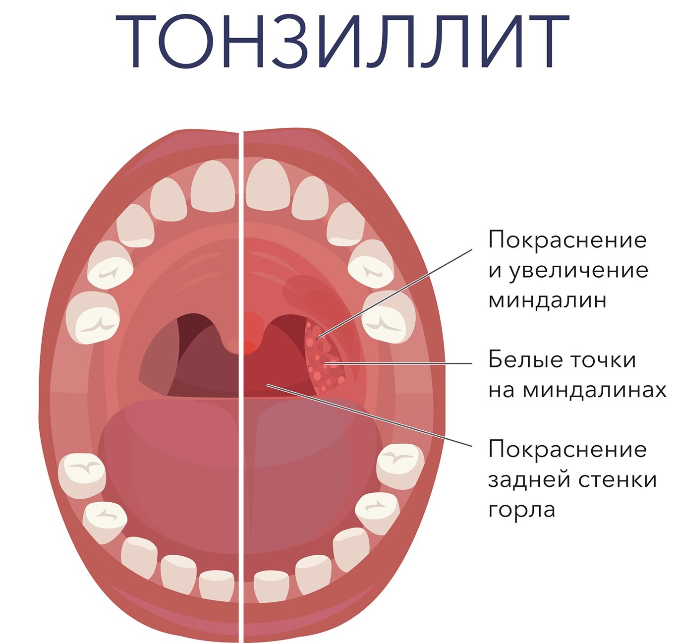 Лечение хронического тонзиллита методом криотерапии | Лор-врач Выкса,  Муром, Кулебаки